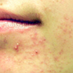 Acne Prone Skin