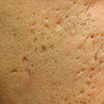 Large Pores/ Acne Scars