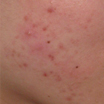 Rosacea Rosacea