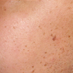 Wart/Nevus