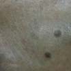 Nevus